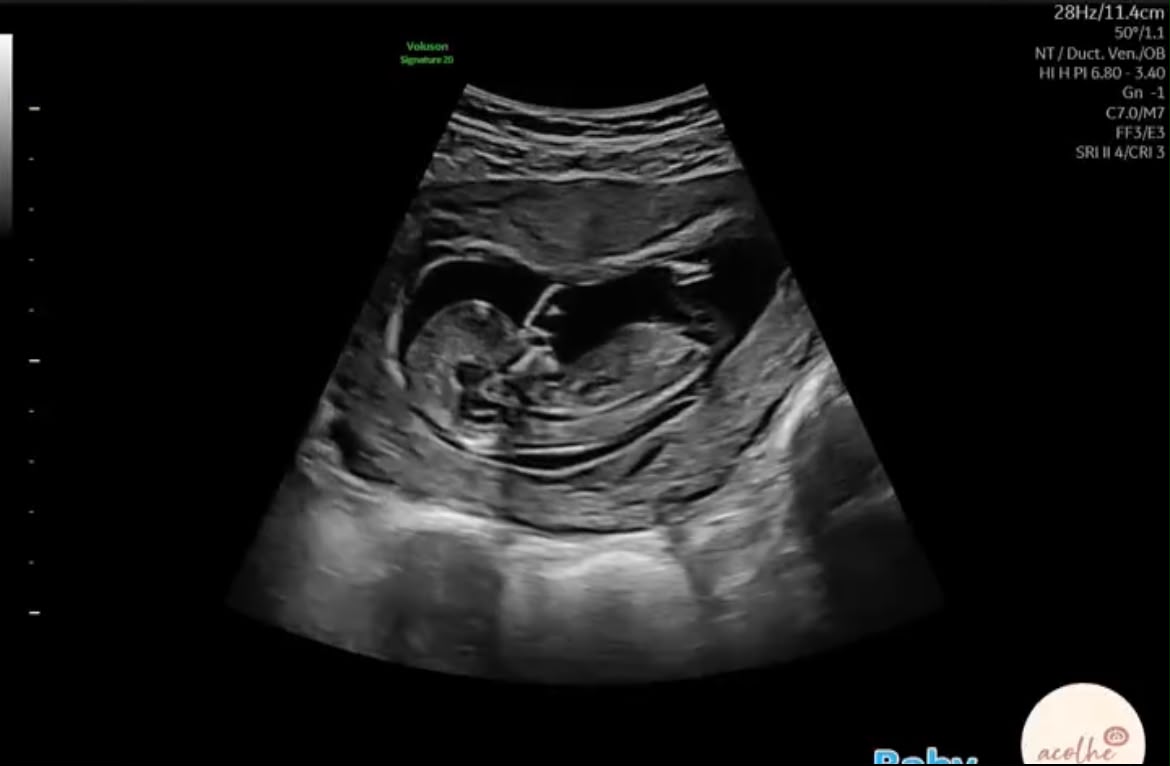Foto do ultrassom do bebê Antônio